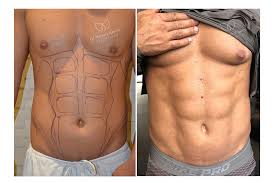 Complete Guide to 6 Pack Abs Surgery