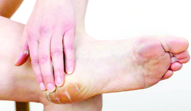 Cracked Heels and Heel Fissures: The Dangers and What You Can Do - Feet  First Clinic