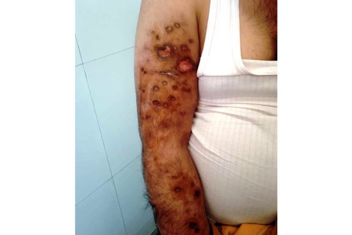 Affected arm of drug addict.